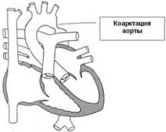 Коарктация аорты врожденное заболевание
